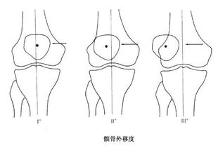 髕骨典故