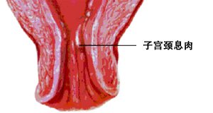 宮頸息肉摘除有哪些方法