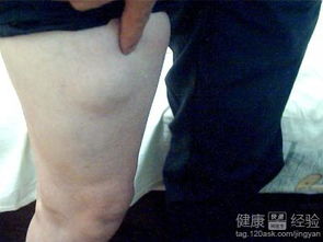 脂肪瘤的中醫治療方法有哪些