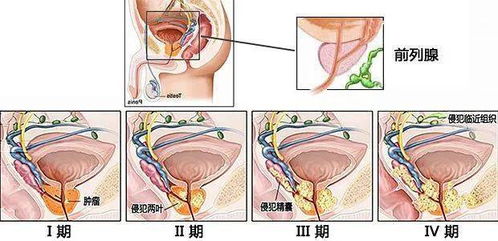 前列腺癌的檢查方法有哪些呢