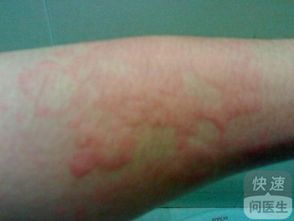 小兒蕁麻疹的護理方法有哪些