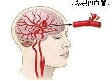 腦出血后遺癥有哪些康復方法