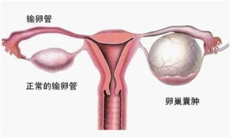 卵巢囊腫治療效果好的方法有哪些