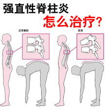 強直性脊柱炎運動(dòng)方法有哪些方法有哪些
