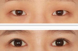 雙眼皮手術(shù)方法都有哪些方法
