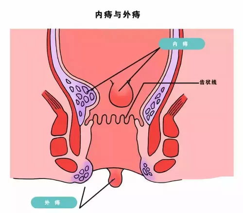 痔瘡治愈的方法有哪些