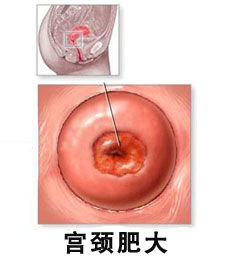 常見(jiàn)的治療宮頸肥大方法有哪些