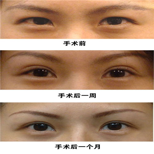 雙眼皮手術(shù)后恢復方法有哪些