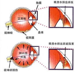 眼壓檢查的方法有哪些
