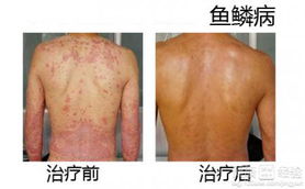 杭州魚(yú)鱗病治療方法有哪些