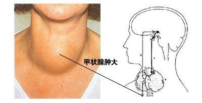 甲狀腺腫大有效治療方法有哪些