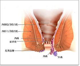 外痔瘡的有效方法有哪些