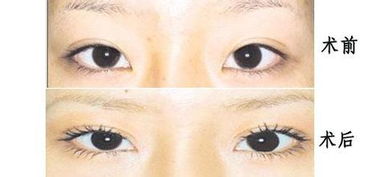 開(kāi)眼角手術(shù)后怎樣護理方法有哪些