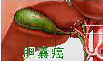 關(guān)于膽的檢查有哪些方法