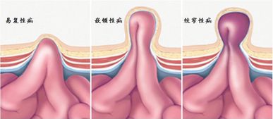 疝氣全麻手術(shù)后注意事項