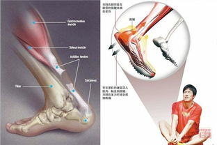 跟腱術(shù)后注意事項,跟腱受傷注意事項,穿跟腱靴注意事項