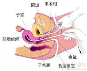 吃藥打胎后需要注意什么,藥流后有什么注意事項,藥物打胎后注意事項有哪些