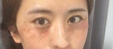 眼袋,割下,注意事項