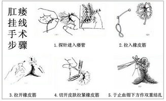 肛瘺,術前,注意事項