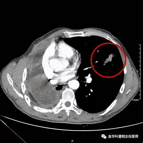 做完pet-ct之后注意事項