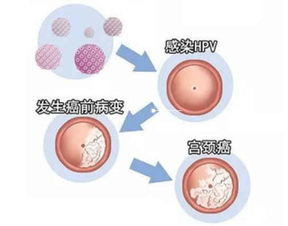 取宮頸hpv標(biāo)本注意事項(xiàng)