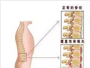 脊柱性關(guān)節炎注意事項