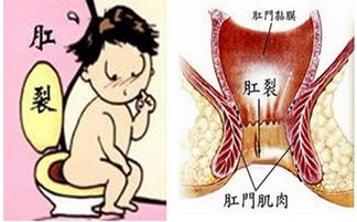 手術(shù)后,注意事項,小孩,肛裂