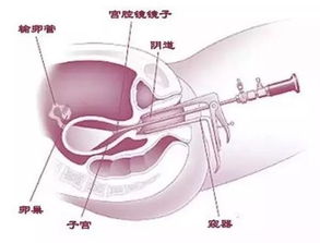 試管宮腔鏡注意事項