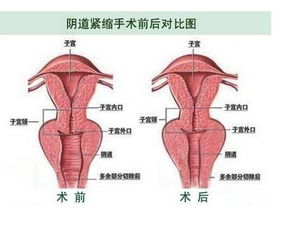 陰道緊縮術(shù)后注意事項