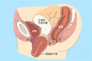 做子宮脫垂修補術(shù)后注意事項