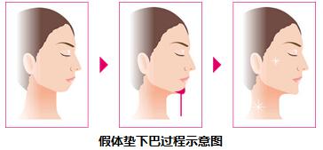 假體下巴做完后的注意事項,假體下巴術(shù)后注意事項,假體下巴飲食注意事項