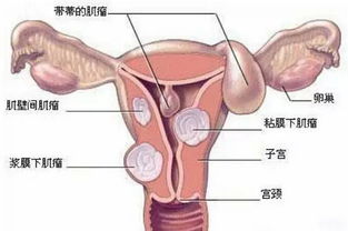 做了子宮肌瘤手術(shù)后注意事項