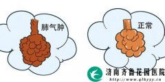 肺氣腫患者應注意事項,肺氣腫多喝水應注意事項,肺氣腫怕累嗎?應注意事項