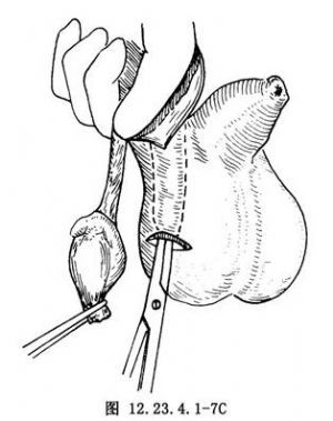 睪丸固定術(shù)術(shù)后注意事項