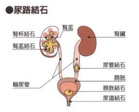 尿道,結石,注意事項,飲食