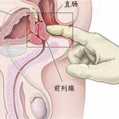 前列腺發(fā)炎注意事項