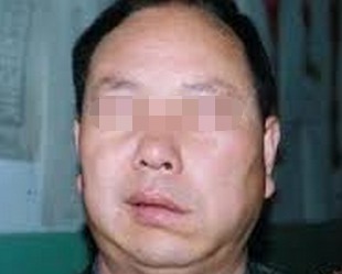 面癱好了以后需要注意什么,面癱治愈后應注意什么,面癱痊愈后注意事項