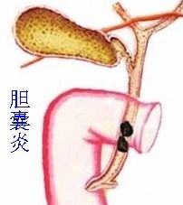 膽結石切膽后注意事項