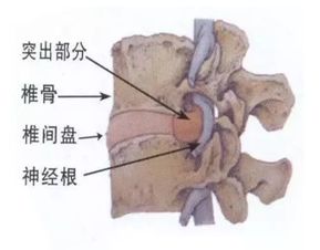 注意事項,患者,腰椎間盤(pán)突出