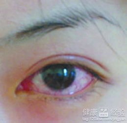 在線(xiàn),結膜炎,大夫,注意事項
