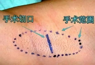 腋臭微創(chuàng  )術(shù)后注意事項