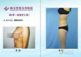 腰腹吸脂術(shù)后注意事項細節(jié),腹部吸脂術(shù)后注意事項,面部吸脂術(shù)后注意事項