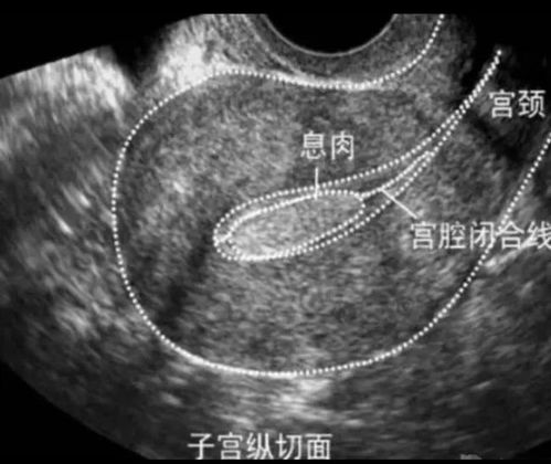 嗓子息肉術(shù)后注意事項(xiàng)
