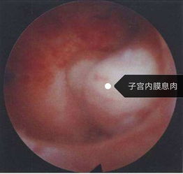 手術后,注意事項,宮腔鏡