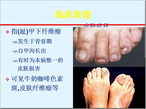 結節性硬化癥注意事項