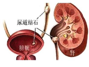 尿道結石術(shù)后注意事項