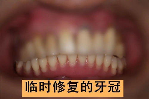 臨時(shí)牙冠上后注意事項