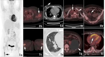 做完,注意事項,pet,ct