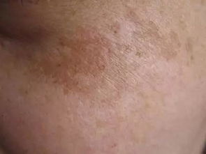 長(cháng)痘痘洗臉怎么注意事項