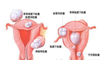 宮頸肌瘤術(shù)后注意事項